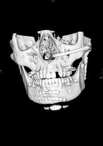 image of fractured skull