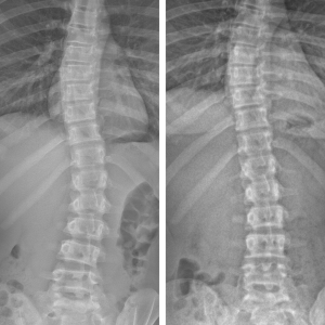 X-rays of Olivia's spine before and after wearing the brace for three years