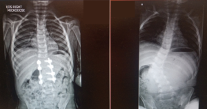 Two x-ray scans side by side, showing the patient's spine before and after surgery